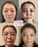 糸リフト / 脂肪吸引（顔） / 下まぶたたるみ取り / 眉下切開 / 脂肪注入（額） / 脂肪注入（輪郭） e:Top clinic（イートップクリニック） AFTER サムネイル用