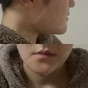 骨切り（あご） / 脂肪吸引（顔） / その他（輪郭） 銀座マイアミ美容外科 DAY 21 サムネイル用