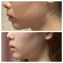 RF（高周波）たるみ治療 東京皮膚科・形成外科　品川院 DAY 3 サムネイル用