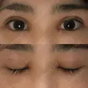 二重埋没 / 目頭切開 / 上まぶたの脂肪取り 湘南美容クリニック 柏院 DAY 12 サムネイル用