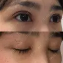 二重埋没 / 目頭切開 / 上まぶたの脂肪取り 湘南美容クリニック 柏院 DAY 12 サムネイル用