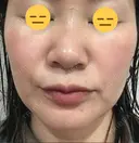 糸リフト / 脂肪吸引（顔） / ボトックス（エラ・小顔） 銀座マイアミ美容外科 DAY 24 サムネイル用