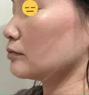 糸リフト / 脂肪吸引（顔） / ボトックス（エラ・小顔） 銀座マイアミ美容外科 DAY 24 サムネイル用