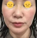 糸リフト / 脂肪吸引（顔） / ボトックス（エラ・小顔） 銀座マイアミ美容外科 DAY 25 サムネイル用