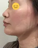 糸リフト / 脂肪吸引（顔） / ボトックス（エラ・小顔） 銀座マイアミ美容外科 DAY 25 サムネイル用