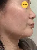 糸リフト / 脂肪吸引（顔） / ボトックス（エラ・小顔） 銀座マイアミ美容外科 DAY 25 サムネイル用