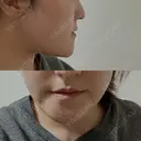 骨切り（あご） / 脂肪吸引（顔） / その他（輪郭） 銀座マイアミ美容外科 DAY 28 サムネイル用