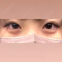 ヒアルロン酸注入（涙袋） 渋谷美容外科クリニック 新宿院 DAY 7 サムネイル用