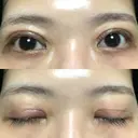 二重切開 / その他（目元） LIKI CLINIC KOBE DAY 22 サムネイル用