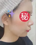 隆鼻術 / 鼻尖形成（切開） / 小鼻縮小（切開） / 軟骨移植 あいちビューティークリニック栄本院 AFTER サムネイル用