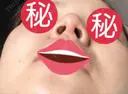 隆鼻術 / 鼻尖形成（切開） / 小鼻縮小（切開） / 軟骨移植 あいちビューティークリニック栄本院 DAY 84 サムネイル用