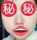 隆鼻術 / 鼻尖形成（切開） / 小鼻縮小（切開） / 軟骨移植 あいちビューティークリニック栄本院 DAY 84 サムネイル用