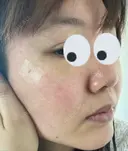 シミ取りレーザー / 光治療（フォトフェイシャルなど） 渋谷美容外科クリニック 新橋院 DAY 12 サムネイル用