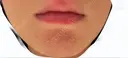ダーマペン 品川スキンクリニック表参道院 DAY 4 サムネイル用