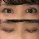 二重埋没 / 目頭切開 / 上まぶたの脂肪取り 湘南美容クリニック 柏院 DAY 13 サムネイル用