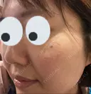 シミ取りレーザー / 光治療（フォトフェイシャルなど） 渋谷美容外科クリニック 新橋院 DAY 14 サムネイル用