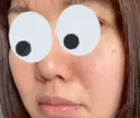 シミ取りレーザー / 光治療（フォトフェイシャルなど） 渋谷美容外科クリニック 新橋院 DAY 15 サムネイル用
