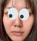 シミ取りレーザー / 光治療（フォトフェイシャルなど） 渋谷美容外科クリニック 新橋院 DAY 15 サムネイル用