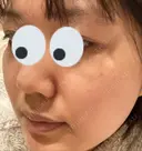 シミ取りレーザー / 光治療（フォトフェイシャルなど） 渋谷美容外科クリニック 新橋院 AFTER サムネイル用