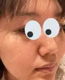 シミ取りレーザー / 光治療（フォトフェイシャルなど） 渋谷美容外科クリニック 新橋院 DAY 17 サムネイル用