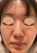 シミ取りレーザー / 光治療（フォトフェイシャルなど） 渋谷美容外科クリニック 新橋院 DAY 17 サムネイル用