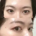 脂肪溶解注射（まぶた） YBC横浜美容外科 大宮院 AFTER サムネイル用