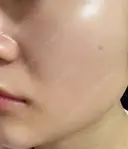 ピーリング（ニキビ・毛穴） 渋谷美容外科クリニック 横浜院 AFTER サムネイル用