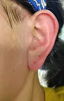 切開リフト LIKI CLINIC KOBE DAY 15 サムネイル用