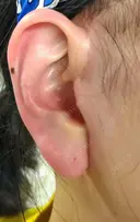 切開リフト LIKI CLINIC KOBE DAY 15 サムネイル用