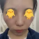 レーザートーニング（美白・肝斑） 渋谷美容外科クリニック 池袋院 DAY 0 サムネイル用
