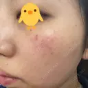 レーザートーニング（美白・肝斑） 渋谷美容外科クリニック 池袋院 DAY 0 サムネイル用