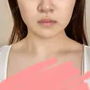 バッカルファット除去 / 脂肪吸引（顔） 湘南美容クリニック 新潟院 DAY 29 サムネイル用