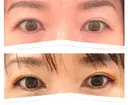 目頭切開 目白ポセンシアクリニック DAY 8 サムネイル用