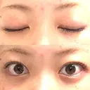 二重埋没 心斎橋中央クリニック AFTER サムネイル用