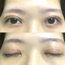 二重切開 / その他（目元） LIKI CLINIC KOBE DAY 35 サムネイル用