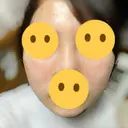ピーリング（ニキビ・毛穴） 渋谷美容外科クリニック 新宿院 AFTER サムネイル用
