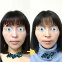 切開リフト LIKI CLINIC KOBE DAY 18 サムネイル用