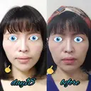 切開リフト LIKI CLINIC KOBE DAY 18 サムネイル用