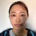 目頭切開 / タレ目形成・グラマラスライン（切開） / 口角挙上 / ボトックス（あご） / その他（口元） 東京形成美容外科 船橋院 DAY 2 サムネイル用