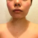 ボトックス（首） KOBE美容皮膚科 西宮院 DAY 10 サムネイル用
