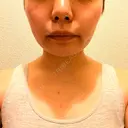 ボトックス（首） KOBE美容皮膚科 西宮院 DAY 9 サムネイル用
