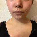 ボトックス（首） KOBE美容皮膚科 西宮院 DAY 8 サムネイル用