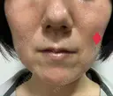 ハイフ（顔） 湘南美容クリニック 大阪京橋院 DAY 4 サムネイル用