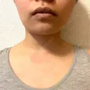 ボトックス（首） KOBE美容皮膚科 西宮院 DAY 11 サムネイル用