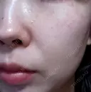 ピーリング（ニキビ・毛穴） / エレクトロポレーション / 光治療（フォトフェイシャルなど） AURORA CLINIC（オーロラクリニック）新宿院 AFTER サムネイル用