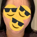 脂肪吸引（顔） / 切開リフト 百人町アルファクリニック DAY 397 サムネイル用