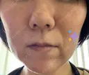 ハイフ（顔） 湘南美容クリニック 大阪京橋院 DAY 7 サムネイル用