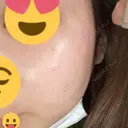 光治療（フォトフェイシャルなど） / ピーリング（ハリ・ツヤ） AURORA CLINIC（オーロラクリニック）新宿院 AFTER サムネイル用