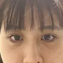 目尻切開 / タレ目形成・グラマラスライン（切開） A CLINIC（エークリニック） 銀座院 DAY 9 サムネイル用