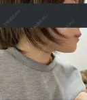 骨切り（あご） 銀座マイアミ美容外科 AFTER サムネイル用